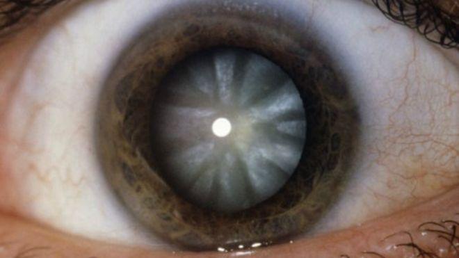 160309213038_eye_512x288_spl_nocredit