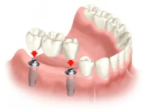 multiple_teeth_implants