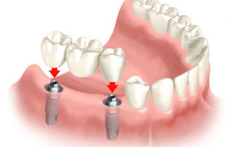 多牙缺失可能是认知功能障碍症的病征