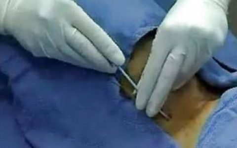 颈内静脉反复穿刺安全吗？