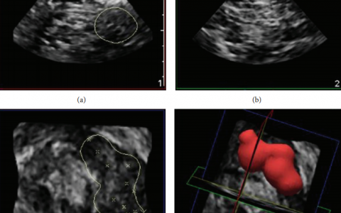 四维超声在神经阻滞中的应用