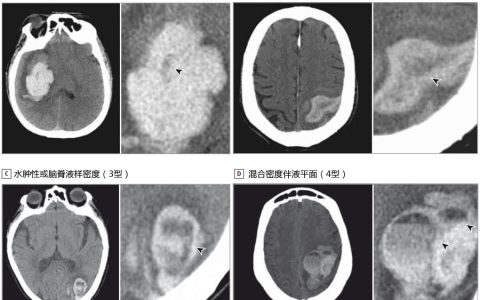 JAMA Neurol：急性脑出血后如何预测血肿扩大？