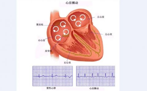 Heart Rhythm：房颤患者脑容量可能会减少。