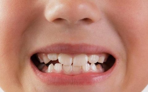 牙齿和儿童的嗜睡有关？