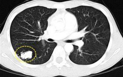 Radiology：CT检查可降低肺结节的活检和手术率。
