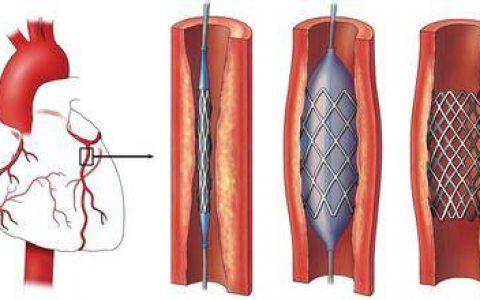 J Am Coll Cardiol：STEMI患者急诊PCI前早期静脉注射β受体阻滞剂能否获益？