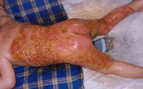 中华烧伤杂志：低剂量糖皮质激素可降低严重烧伤患者并发症发生率