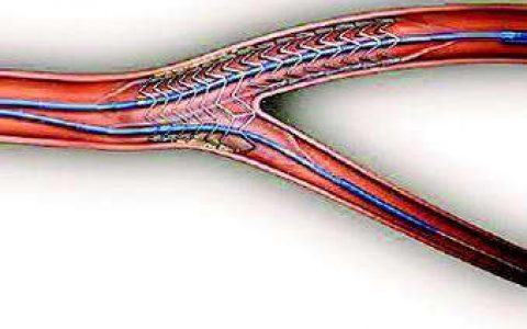 JAMA Cardiology:心脏支架手术后患者DAPT治疗可能至少需要6个月