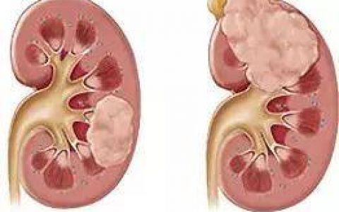 The Lancet：转移性肾癌患者不必急于进行治疗