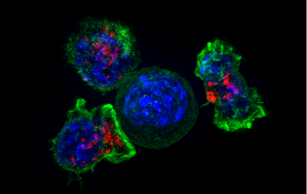 癌细胞周围的杀手T细胞