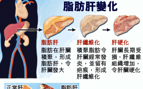 中国科学家发现脂肪肝的病因