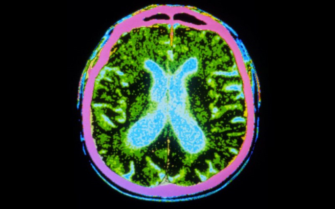 猪脑子的希望——猪的脑细胞被移植到帕金斯病人脑中