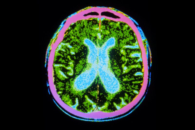 猪脑子的希望——猪的脑细胞被移植到帕金斯病人脑中
