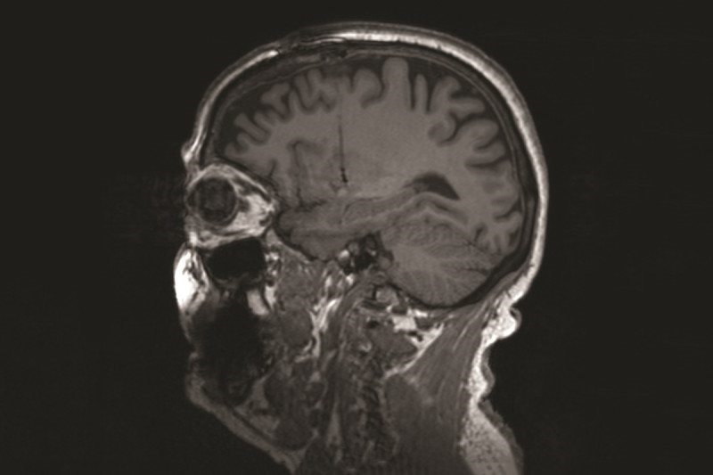 猪脑子的希望——猪的脑细胞被移植到帕金斯病人脑中