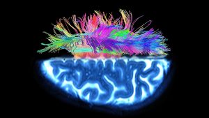 麻醉和手术可能影响小儿大脑白质结构