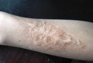 何必为疤痕所苦恼——疤痕增生的治疗小技巧