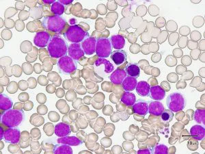 新的研究揭示血癌是怎样“窃取”骨髓细胞的？
