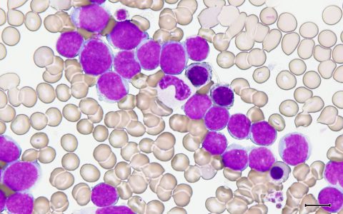 新的研究揭示血癌是怎样“窃取”骨髓细胞的?