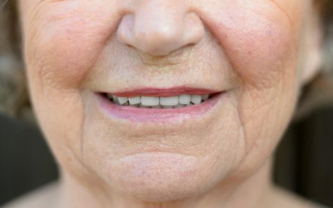 怎样清除你的微笑纹？