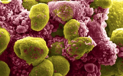 正在经历细胞凋亡的前列腺肿瘤细胞(红)与健康的癌细胞(黄)(图源:ScienceNews )