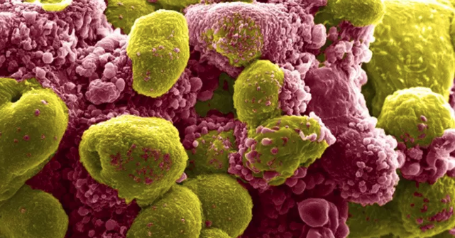正在经历细胞凋亡的前列腺肿瘤细胞（红）与健康的癌细胞（黄）（图源：ScienceNews ）